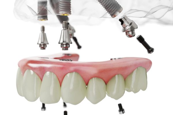 Cấy ghép implant All-on-4 là công nghệ mới đến từ Châu Âu, với thời gian cấy ghép chỉ 10-20 phút